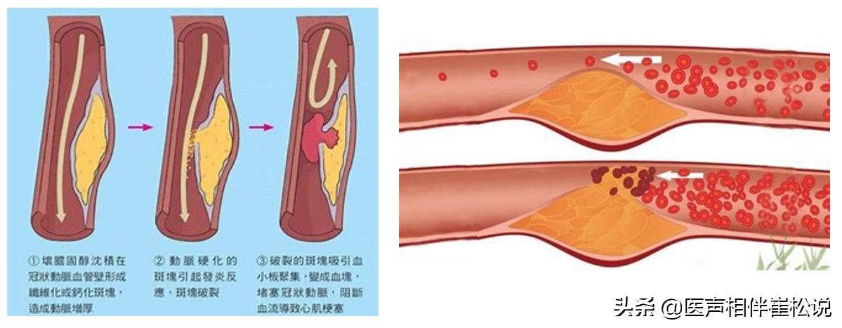 冠心病小红书——治疗的ABCDE