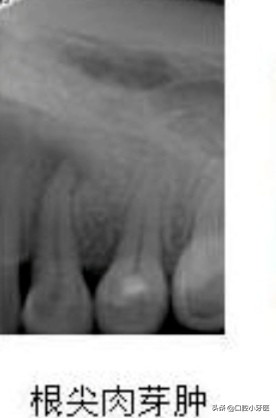 牙齿疼痛难忍吃药后不再疼痛是真的好了吗？事实不是你想的那样！