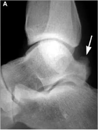 踝关节撞击症问诊,踝关节撞击综合征的x线表现