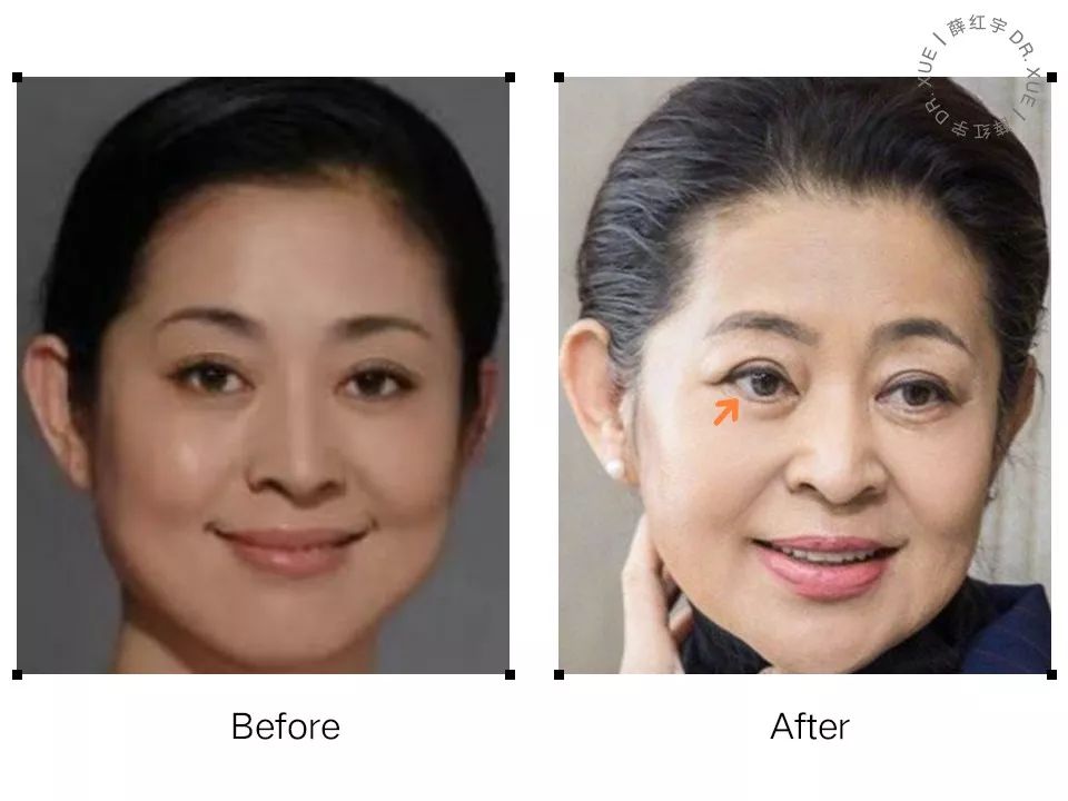 要不要开下眼睑,要不要开内眦赘皮