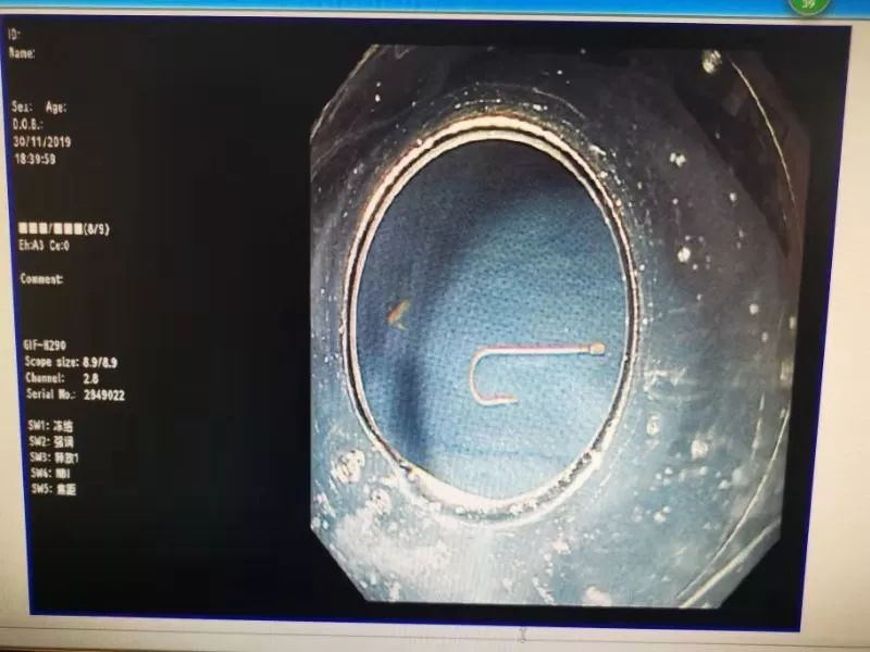 鱼钩剔牙!儋州12岁女孩误吞鱼钩,到院钩子已滑落到十二指肠…