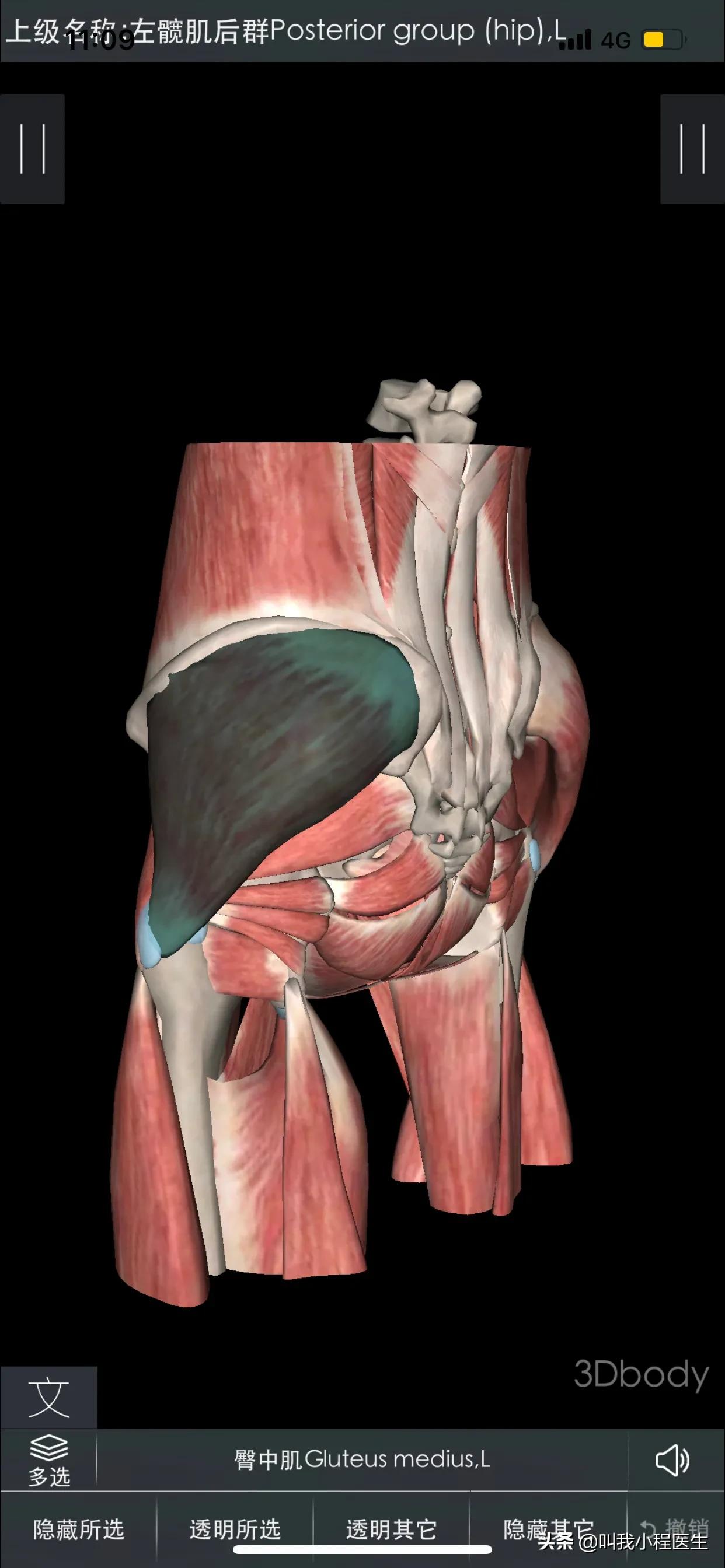 腰椎间盘突出骨质增生可以补钙吗,40岁腰椎间盘突出骨质增生怎么办