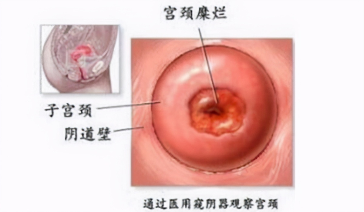有宫颈糜烂可以打hpv疫苗吗,hpv感染合并低级病变