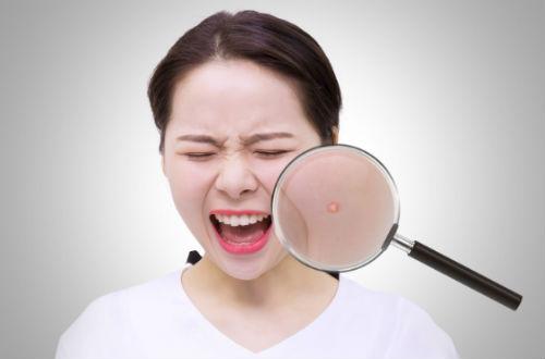 祛完痘后留下的痘印怎么处理,祛完痘痘用什么消炎