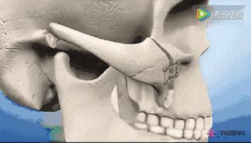 哪个明星做了颧骨内推,颧骨内推明星前后对比