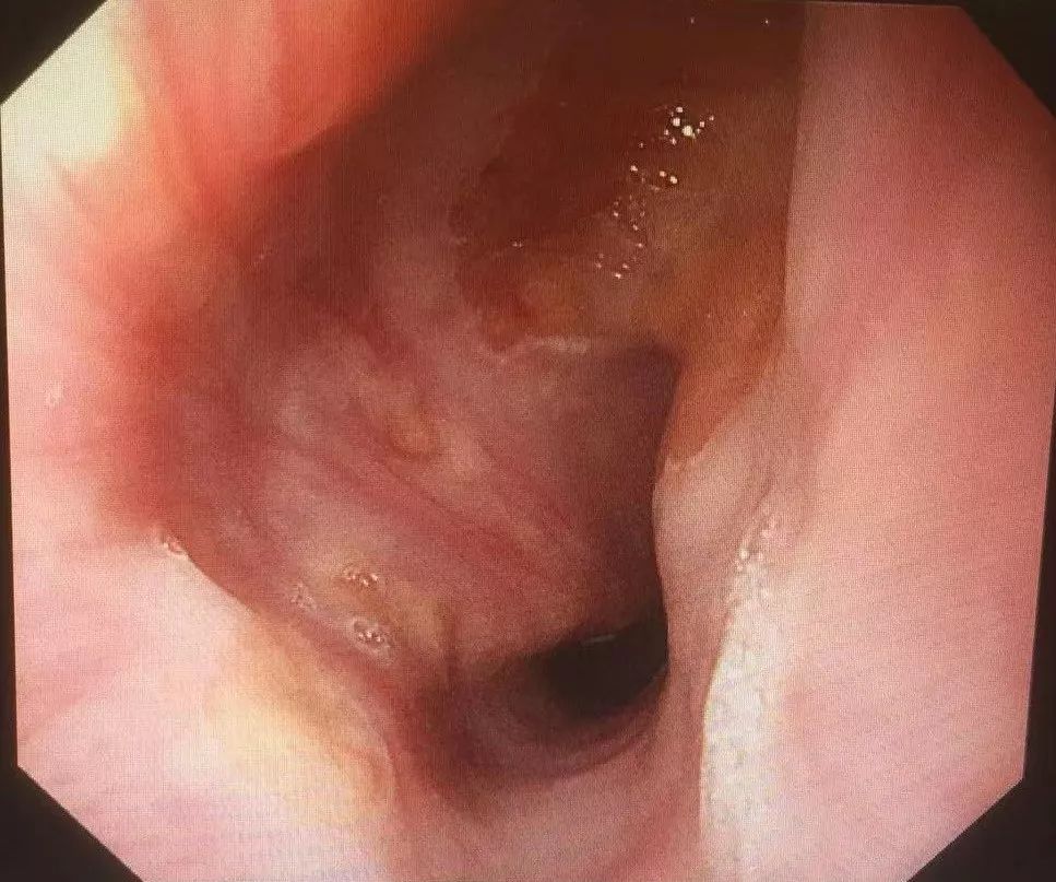 胃食管反流药物治疗一般多久好,胃食管反流需要吃几个疗程的药