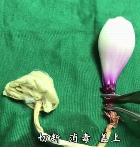 剖腹产手术最重要的步骤,剖腹产要做什么流程