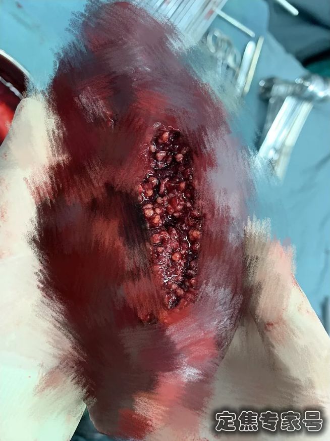 女孩脾脏被异物塞得密密麻麻...医生切开后，吓出一身鸡皮疙瘩！