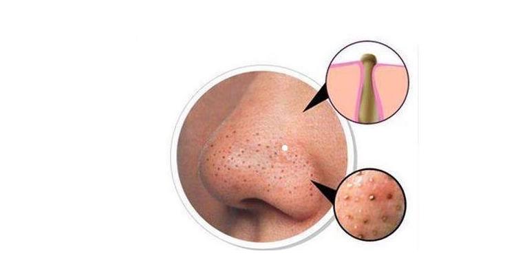 鼻子上挤出的就是螨虫吗,鼻子两边挤出白色的东西是螨虫吗