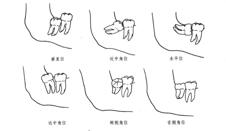 智齿有蛀牙但不痛需要拔掉吗,牙医讲述智齿到底要不要拔