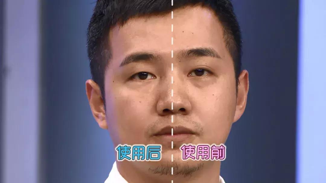 护肤黑科技顶级医美,用黑科技去除眼袋肿了十天