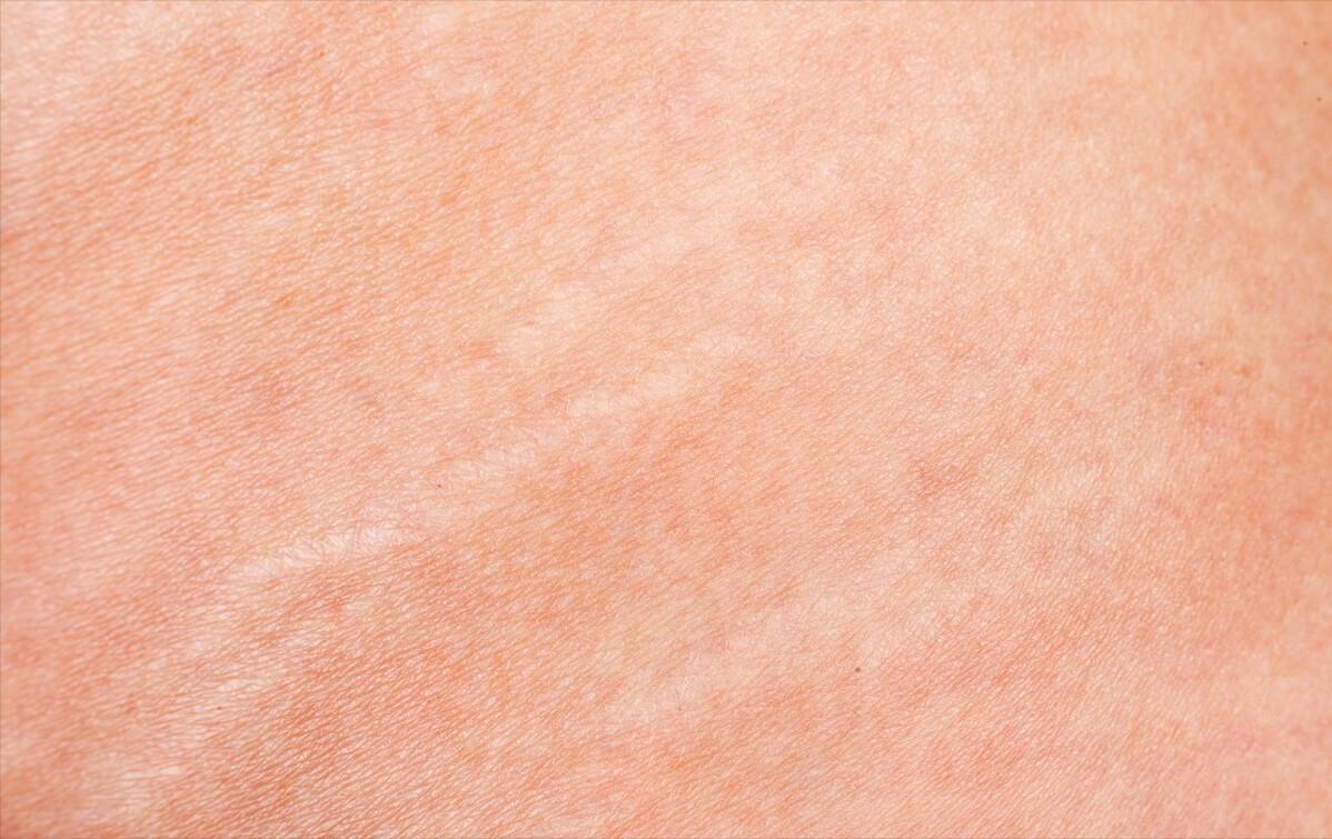 宝宝蚊子叮咬疤痕怎么去除,蚊子叮咬用手抓破后伤好后有疤痕