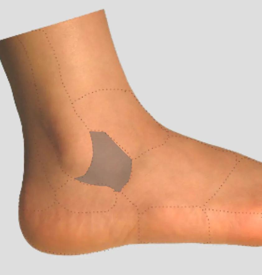 足踝外侧疼痛部位对照表,足踝外侧疼痛的处理方法