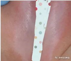 好奇,这个皮肤病居然会逐步阻挡羞羞之路