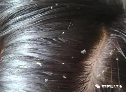 你真正了解ros吗,怎么真正治疗头皮屑