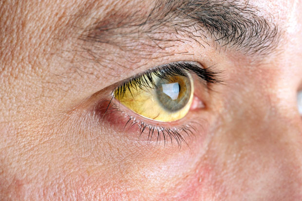 不论男女，身体这5处变黄，十有八九，是你的肝脏在“求救”