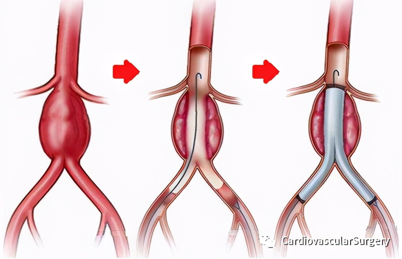 腹主动脉瘤做微创手术的条件,腹主动脉瘤5cm保守治疗能恢复吗