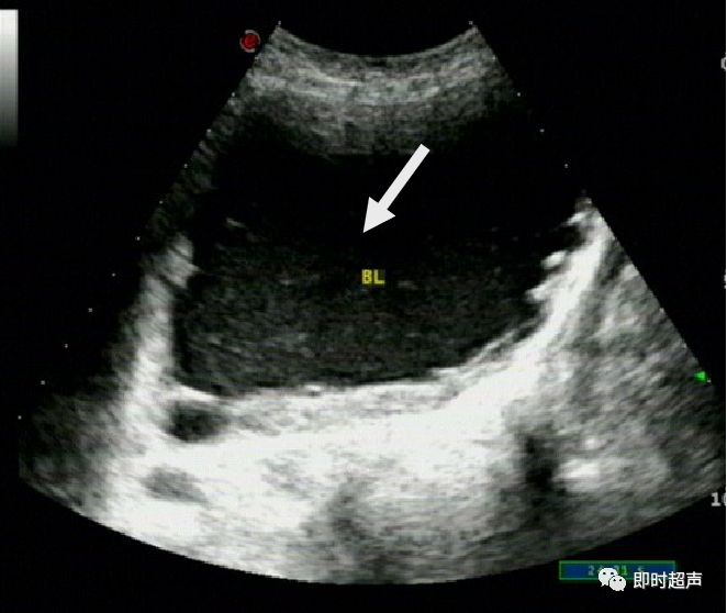 膀胱超声图解大全,膀胱超声解剖及常见病变超声表现
