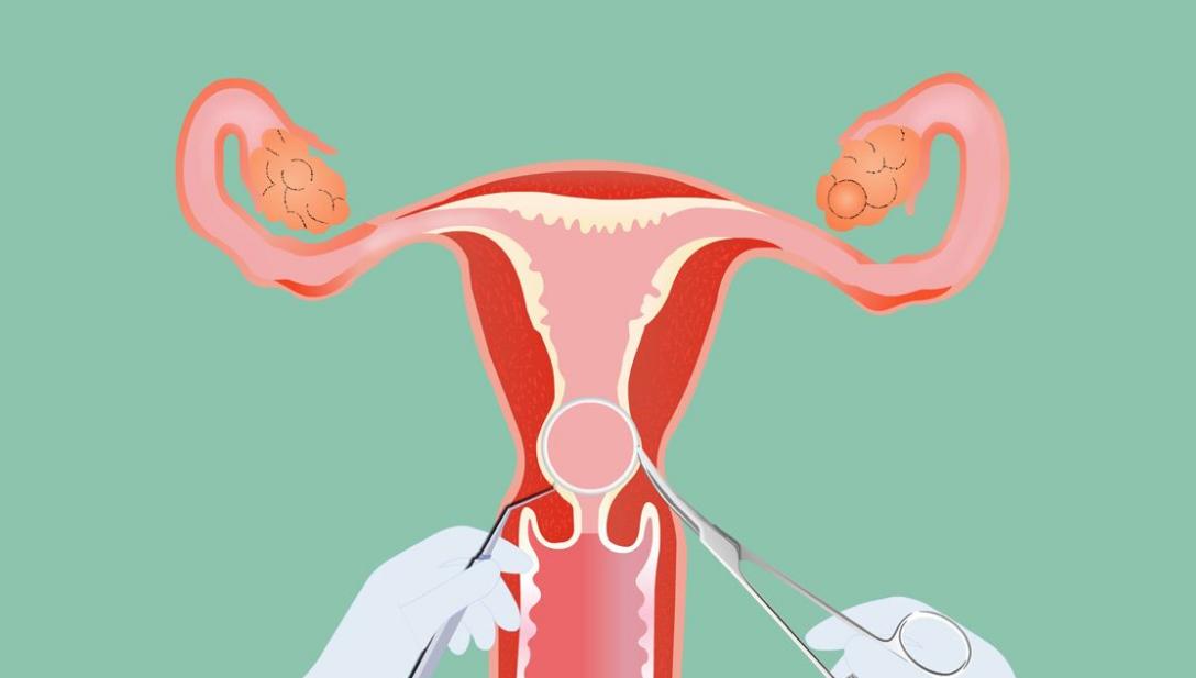 除了放环和结扎还可以怎么避孕,避孕失败后去上环能避免怀孕吗