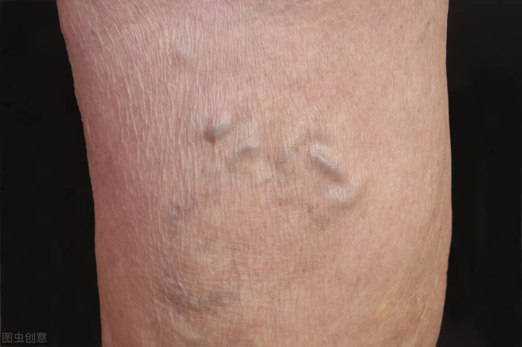 杭州大伯被蜜蜂蜇休克,杭州大伯被蜜蜂蛰休克