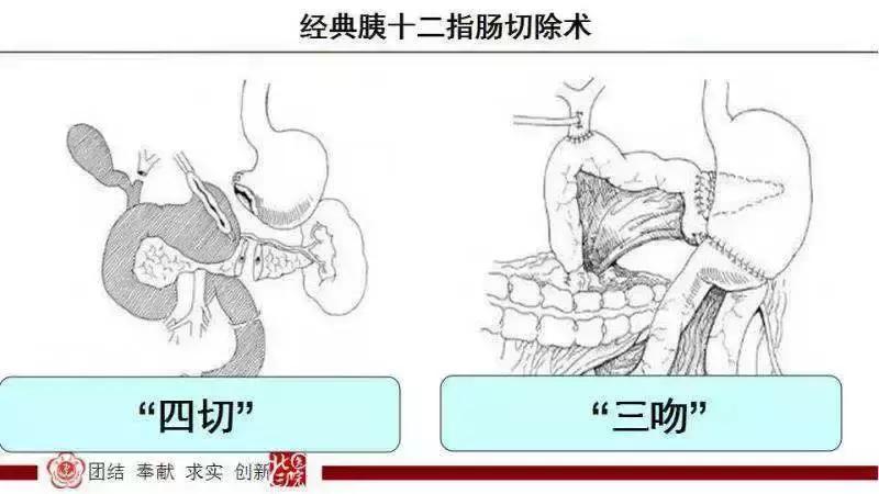 三院外科手术,胰管空肠桥式吻合术世界首创者