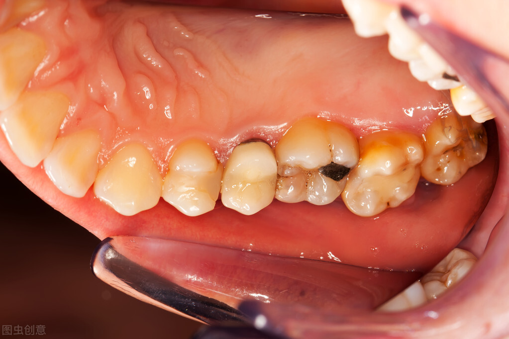 牙龈肿痛淋巴结肿大吃什么药见效,牙龈肿痛吃什么药快速消牙肿止痛