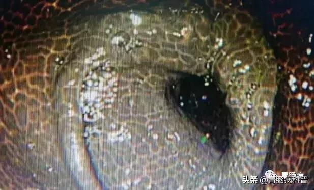 大肠变黑吃什么药好,大肠变黑便秘