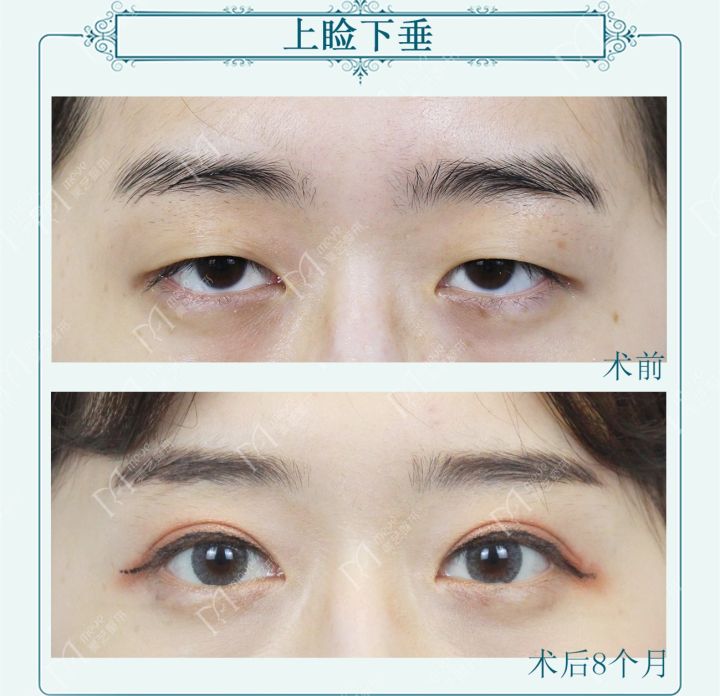为什么有人割了双眼皮反而不好看,为啥有些人割了双眼皮变化巨大