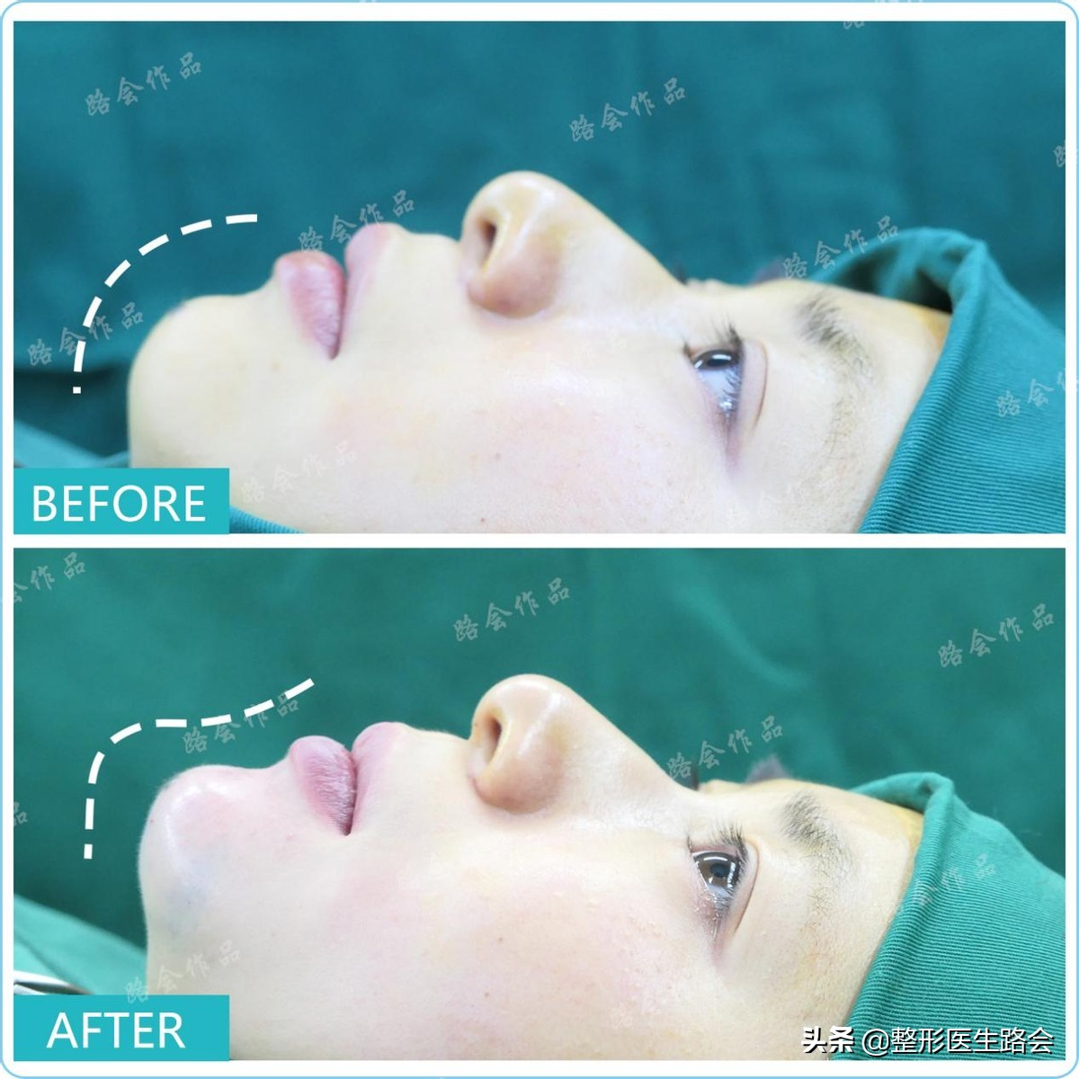 做假体下巴的真实案例,做假体下巴后的真实感受