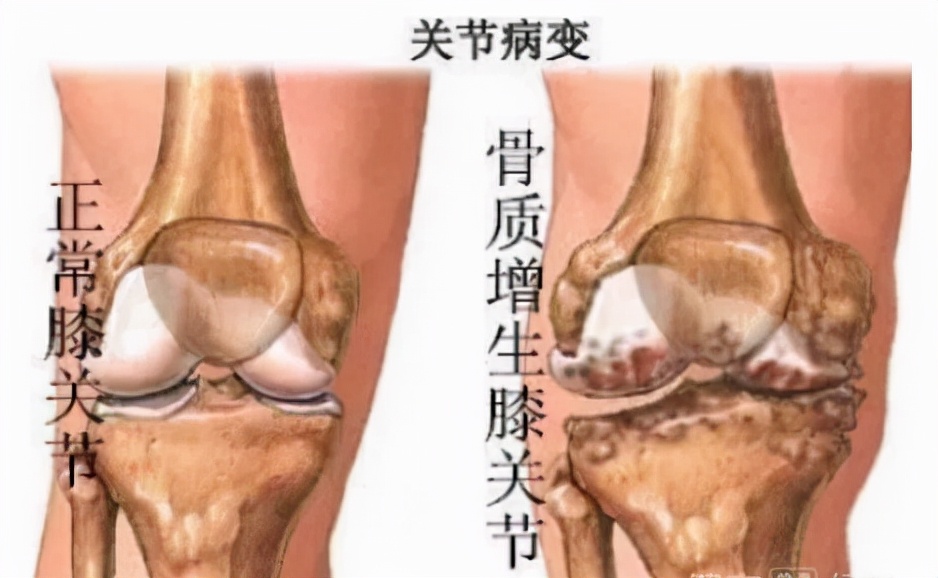 微创手术能治好骨性关节炎吗,膝盖关节镜微创手术要脱衣服吗