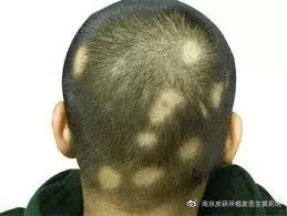女生二十出头头顶就秃了,我的头秃了怎么办