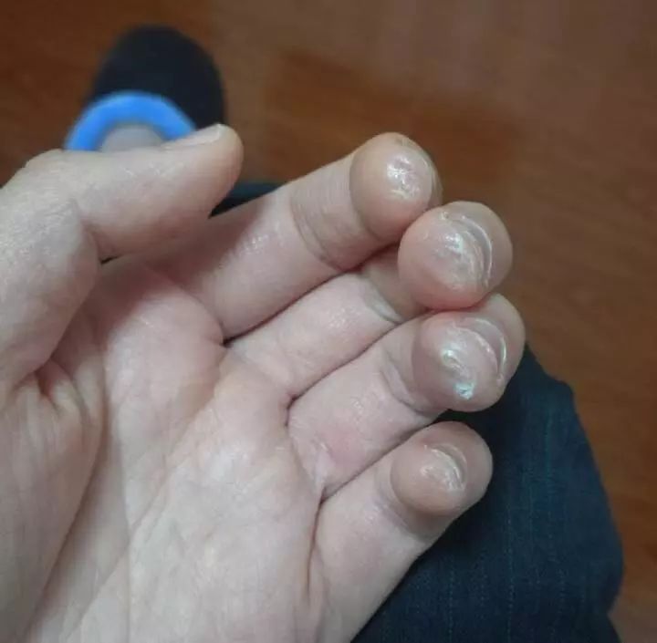 再继续这样弹琴,你的手就要“烂了”