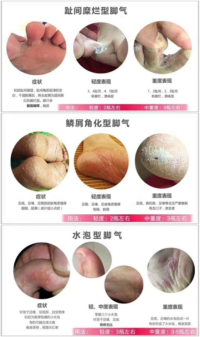 脚气导致的瘙痒特别严重,脚气特别的痒怎样才能彻底解决