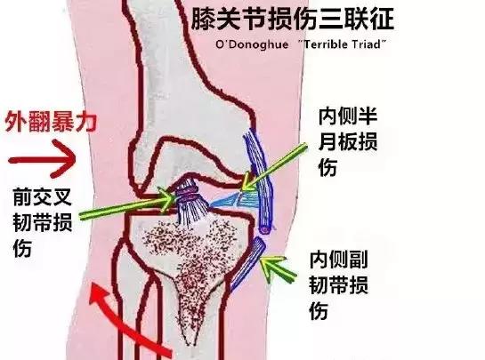 膝关节损伤科普知识,膝关节病的科普知识
