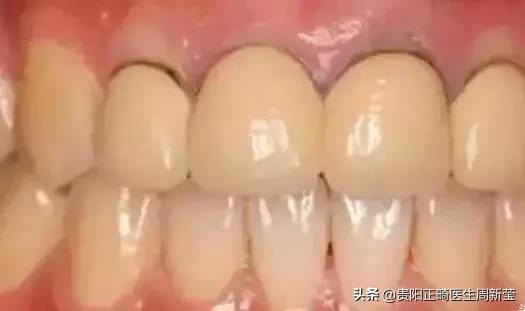 看牙是个漫长痛苦的过程,你以为的看牙费用vs实际看牙费用