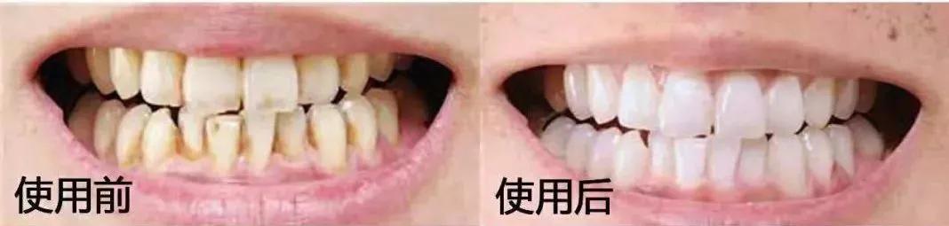 刷牙去牙垢烟垢黄牙最有效方法,刷牙多久才能消除牙黄味