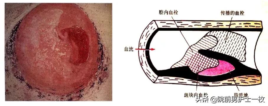 急性心梗的紧急处理视频,一旦发现急性心梗如何救