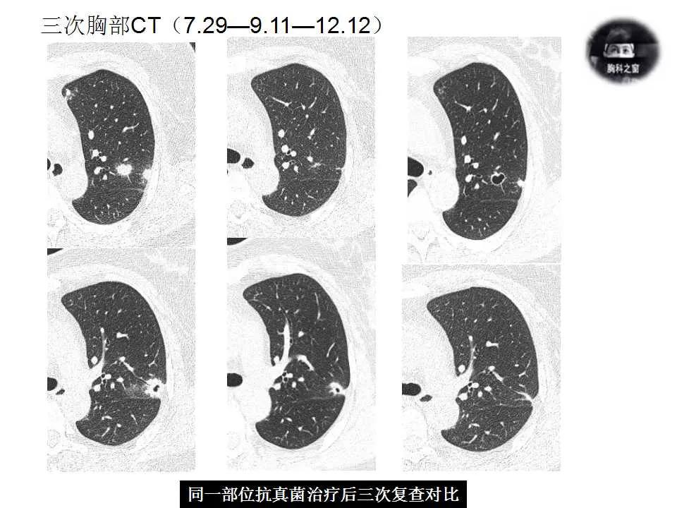双肺多发结节是肺癌的征兆吗,双肺多发结节灶