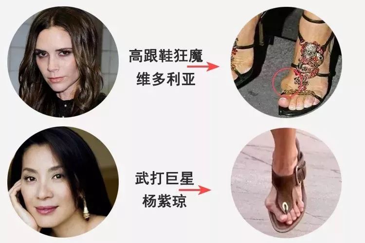 脚趾超级痛,轻度脚趾外翻如何矫正