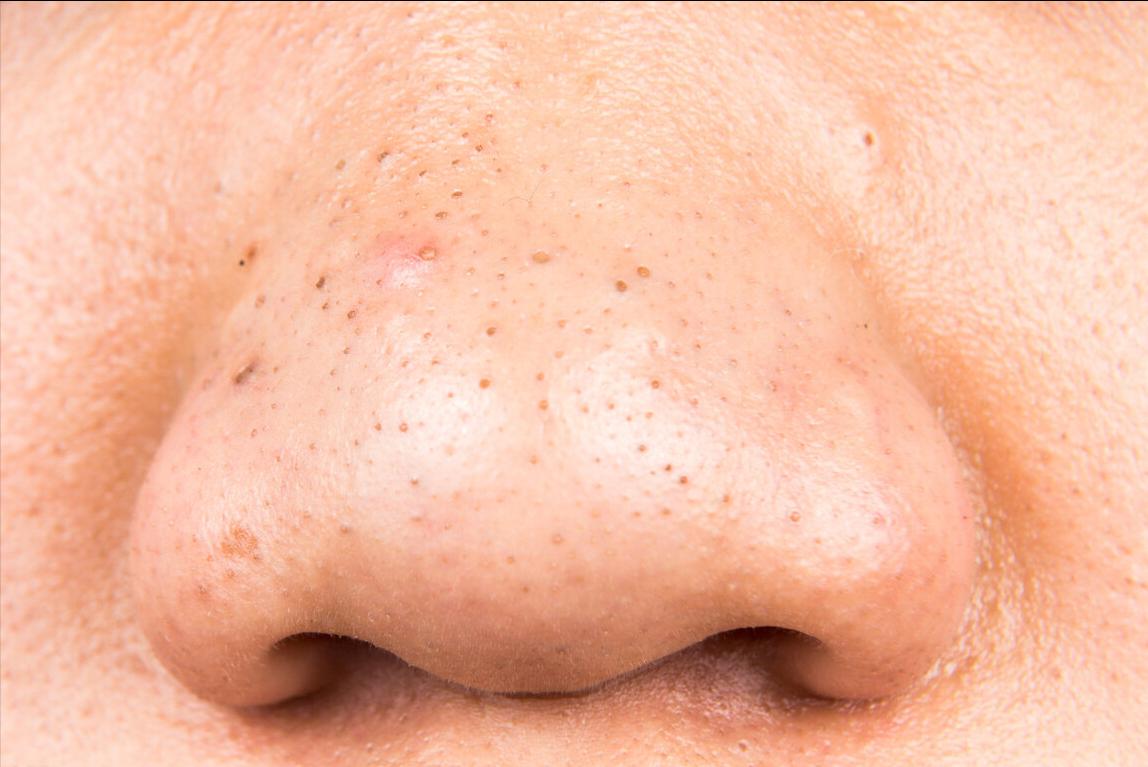 鼻子上的黑头怎么去掉学生,鼻子上的黑头怎么去掉用牙膏