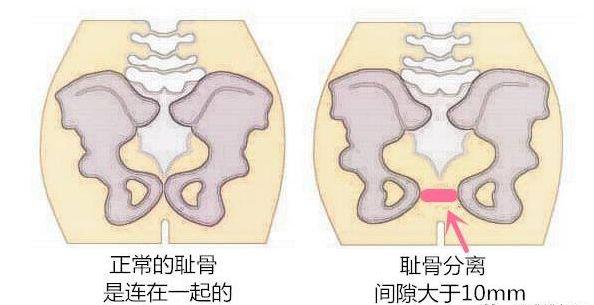 孕晚期耻骨痛翻身会有响声,孕晚期耻骨疼得无法翻身怎么缓解