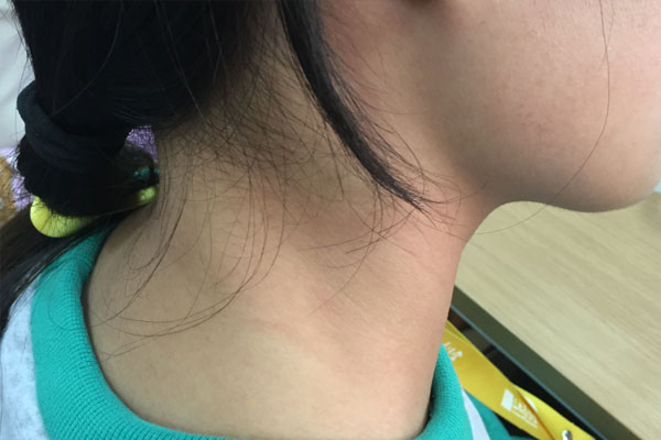 得了甲亢但是没有任何症状,得了甲亢没有症状怎么办