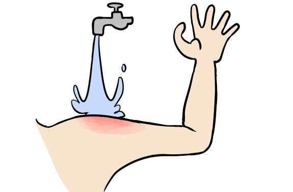 烧烫伤应急处理视频,烧烫伤的应急处理及预防