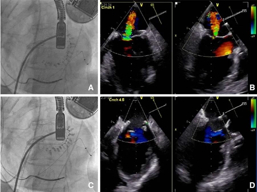 心脏“小门”关不严,经导管二尖瓣介入治疗,不开胸就换瓣