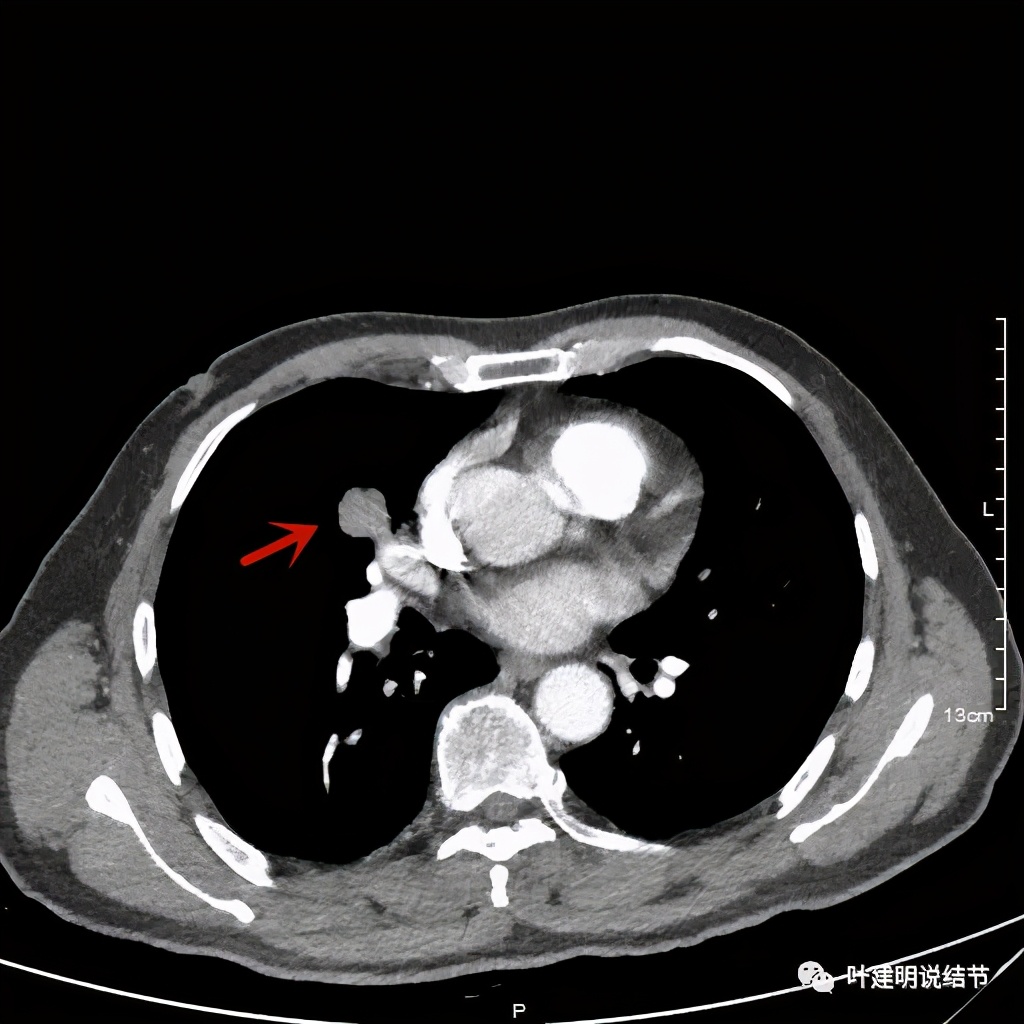 实性结节影要不要紧,实性结节穿刺活检为良性