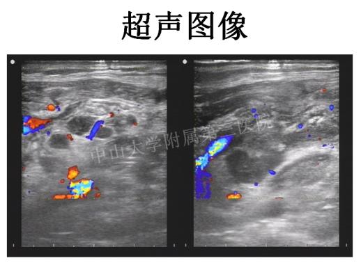 脖子上有个硬疙瘩是癌症吗,脖子结节癌症晚期能治好吗