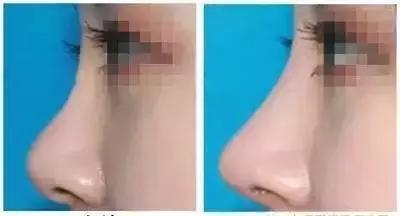 鼻整形后出现肿胀,鼻子整形后假体外露是手术失败吗
