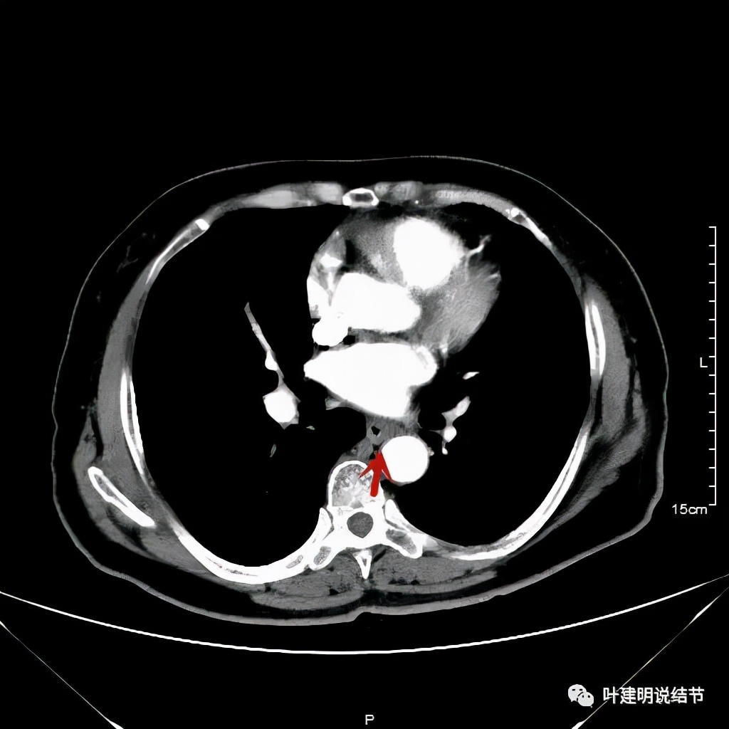 特瑞普利单抗食管癌成功案例,特瑞普利单抗治疗食管癌效果好吗
