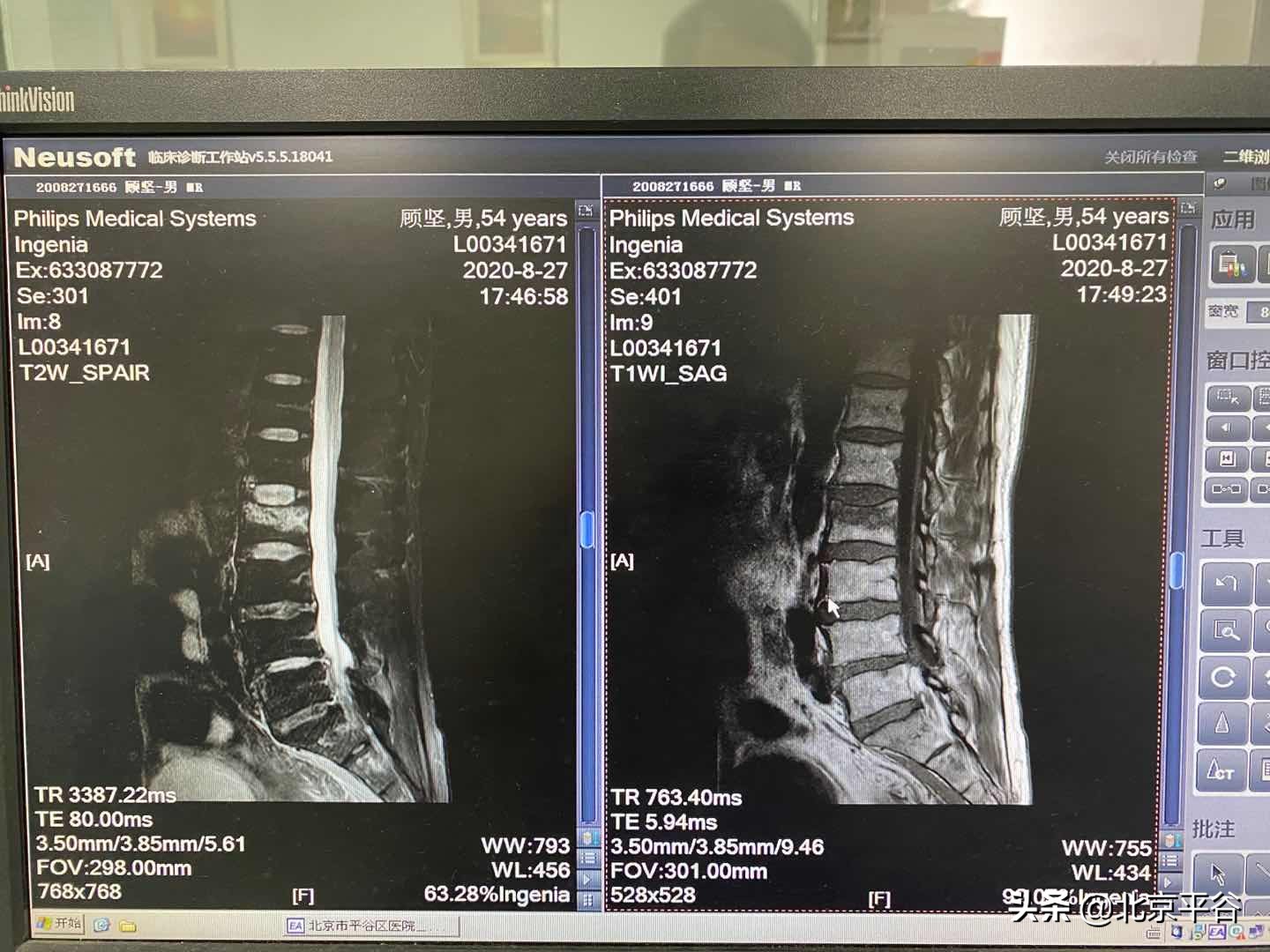 天玑骨科手术机器人操作演示,天玑机器人开创骨科微创先河