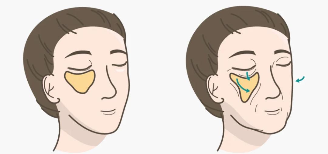 热玛吉法令纹消失了,热玛吉和fotona4d哪个法令纹效果好